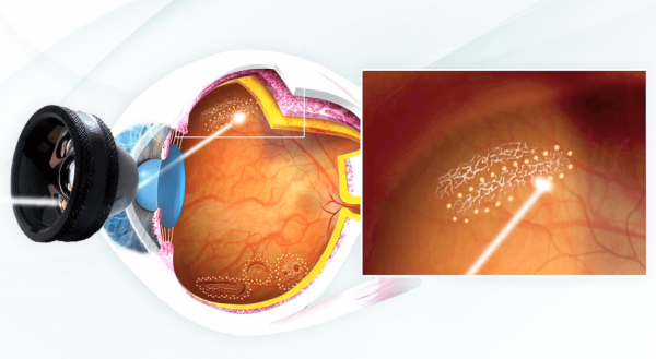 Avaliação especializada da retina periférica